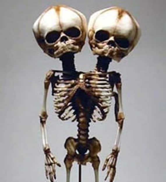 Conjoined Twins Siamese Fetal Skeletons, made to order.