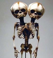 Conjoined Twins Siamese Fetal Skeletons, made to order.