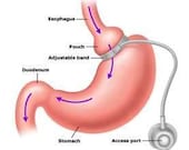 Virtual Gastric Band Surgery Hypnosis