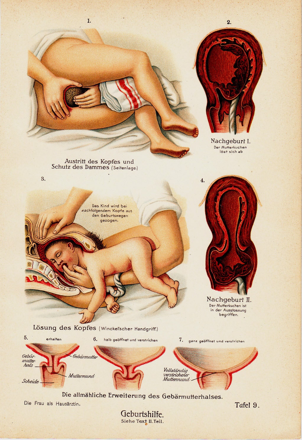 1911 Antique PARTURITION ANATOMY print,  102 years old antique print