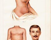 1902 Antique DERMATOLOGY print, skin diseases,  110 years old antique print